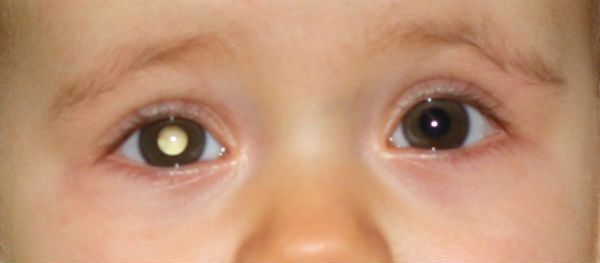 leucocorie cancer de l'oeil rétinoblastome