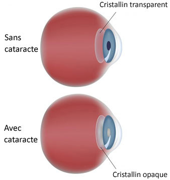 schéma opération cataracte