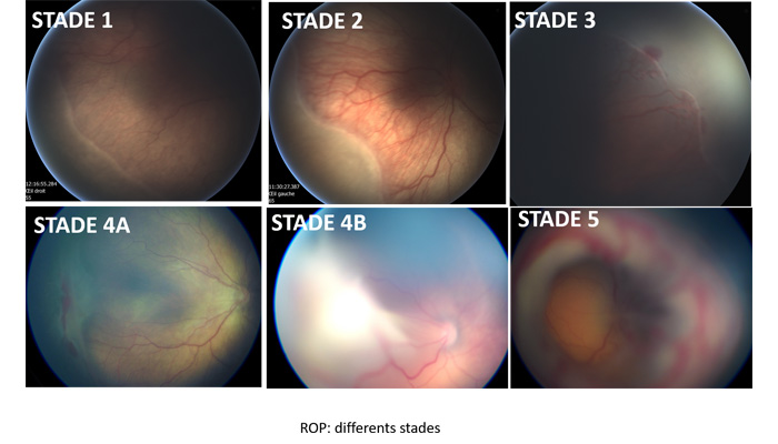 rop-differents-stades-guide-vue.fr