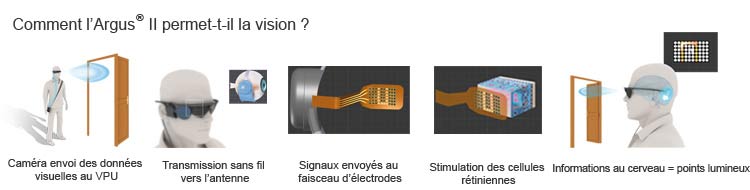 implant rétine oeil