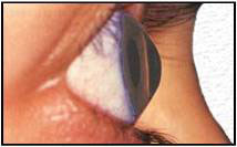 kératocone cornée oeil