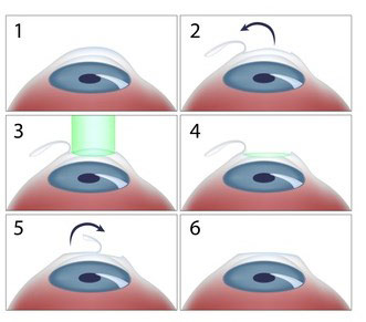 opération lasik