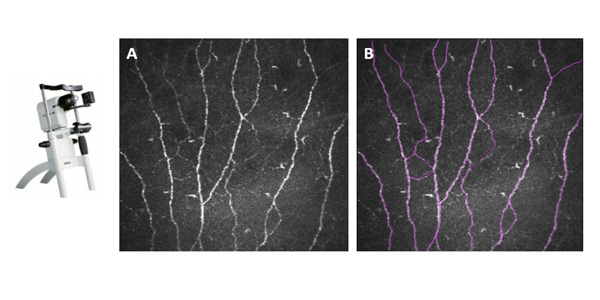 Microscopie Confocale In Vivo