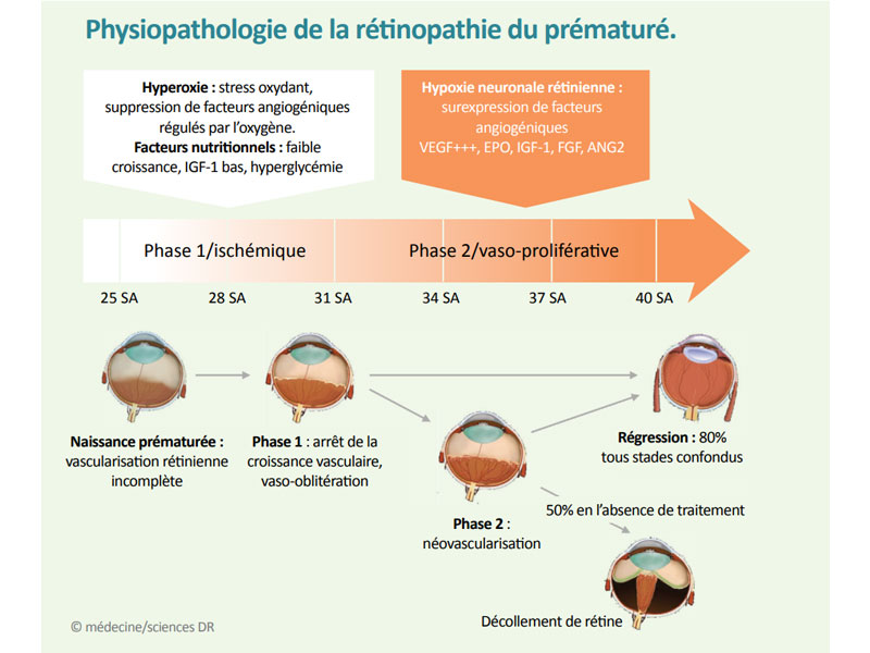physiopathologie-de-la-retinopathie-du-premature-guide-vue.fr