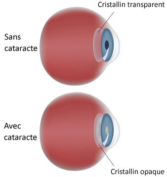 schéma de description de la cataracte de l'oeil