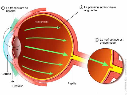 cause glaucome oeil 