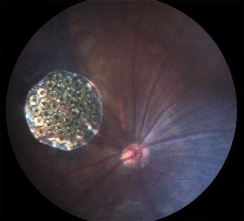 vision rétine artificielle