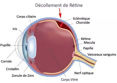 schéma décollement de la rétine