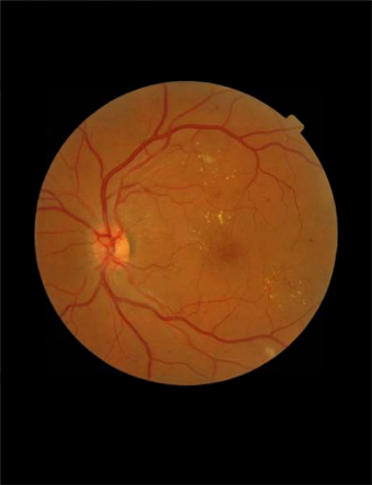 Image originale du fond d'œil