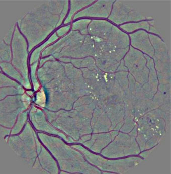 Image prétraitée du fond d'œil