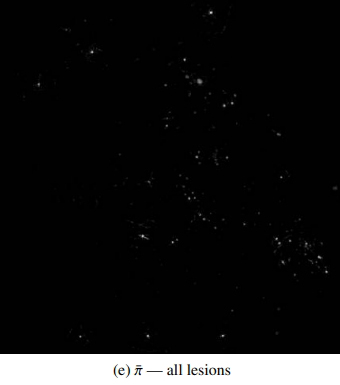 Toutes les lésions du fond d'œil