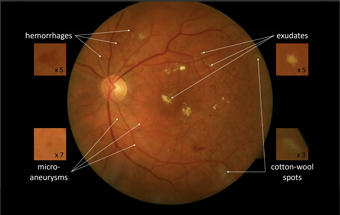  Fond d’œil et lésions les plus communes causées par la rétinopathie diabétique (hémorragies, micro-anévrismes, exsudats, nodules cotonneux), Deep Image Mining for Diabetic Retinopathy Screening, G Quellec et al. (2017)