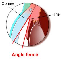 glaucome angle fermé