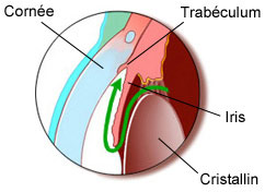 glaucome