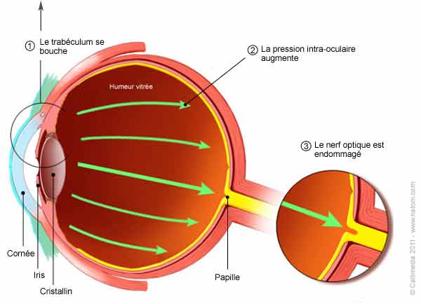 glaucome oeil schéma