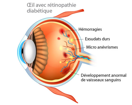 elfbar nachfüll pod läuft aus 🎥Comment utiliser une insuline en stylo ?✨ L'insuline est un traitement  essentiel pour les personnes diabétiques de type 1. Elle permet de réguler  la glycémie en aidant le sucre du sang à