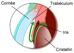 glaucome